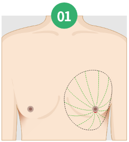 Gynecomastia korea - Gynecomastia in Korea