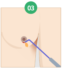 Gynecomastia korea - Gynecomastia in Korea