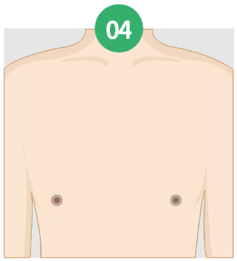 Gynecomastia korea - Gynecomastia in Korea
