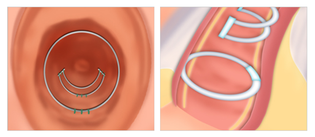 implant vaginoplasty in Korea SH Clinic gangnam seoul