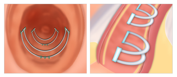 implant vaginoplasty in Korea SH Clinic gangnam seoul