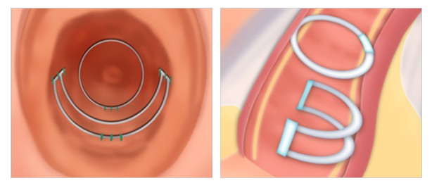 implant vaginoplasty in Korea SH Clinic gangnam seoul