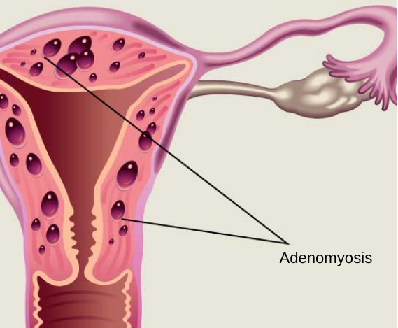 adenomyosis in Korea SH Clinic Gangnam Seoul