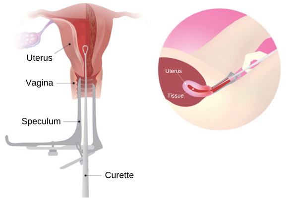 abnormal uterine bleeding in Korea SH Clinic Gangnam Seoul