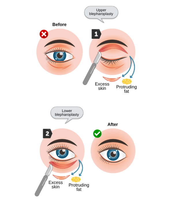 upper blepharoplasty in korea SH Clinic Gangnam Seoul