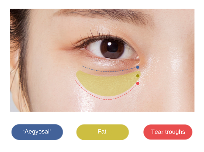 lower blepharoplasty in korea SH Clinic Gangnam Seoul