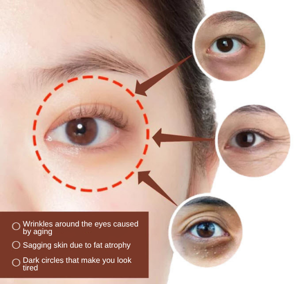 lower blepharoplasty in korea SH Clinic Gangnam Seoul