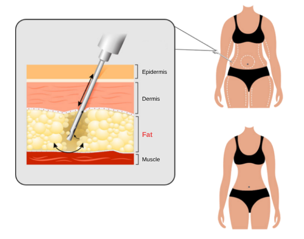 liposuction in Korea SH Clinic Gangnam Seoul