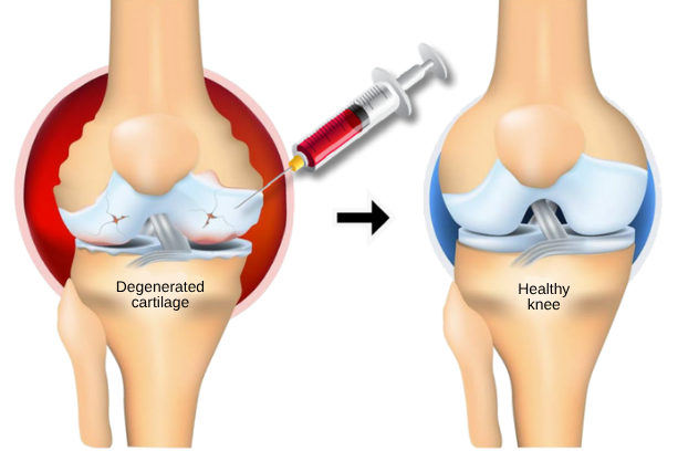 bmac injections for knee arthritis in korea