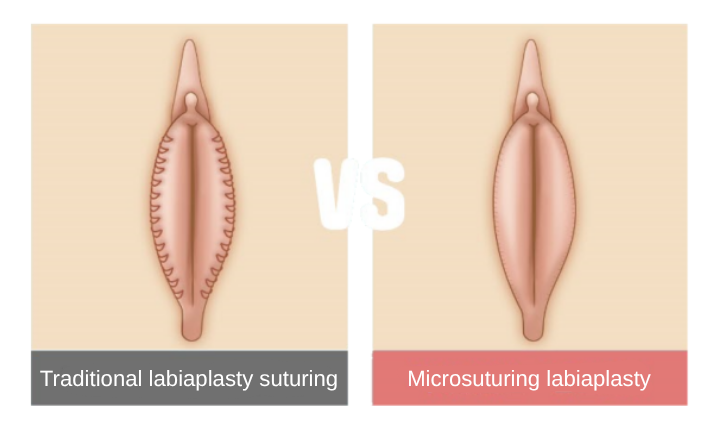 labia minora surgery in Korea SH Clinic Gangnam Seoul labiaplasty