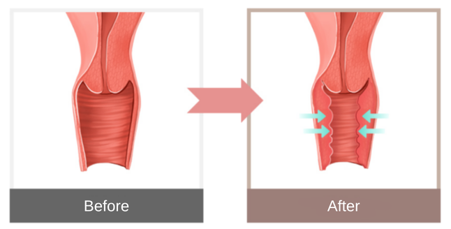 vaginoplasty in Korea SH Clinic Gangnam Seoul