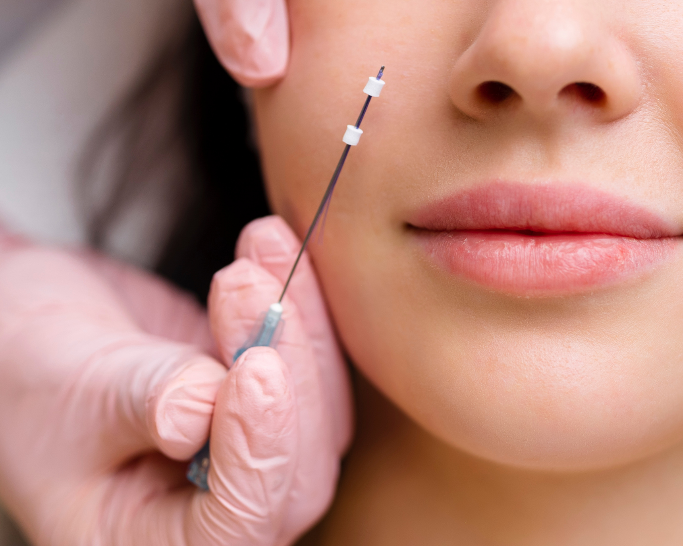 Thread Lifting in Korea at SH Clinic Gangnam Seoul