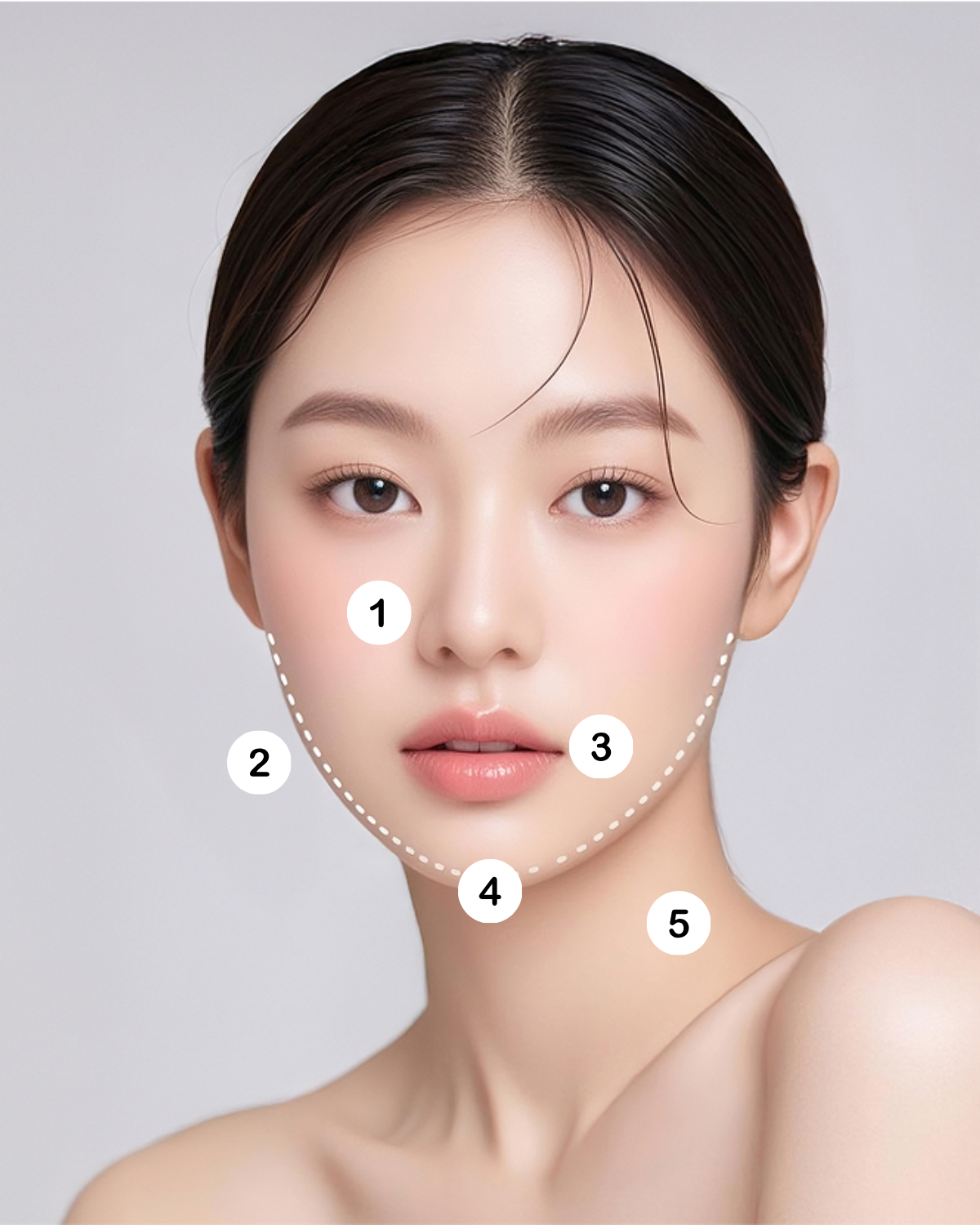 Thread Lifting in Korea at SH Clinic Gangnam Seoul