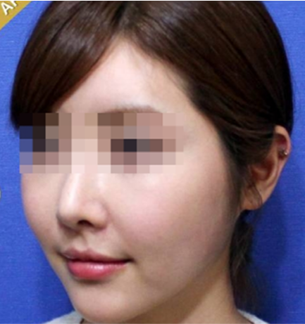 Thread Lifting in Korea at SH Clinic Gangnam Seoul