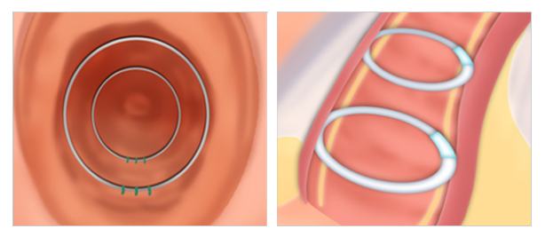 implant vaginoplasty in Korea SH Clinic gangnam seoul