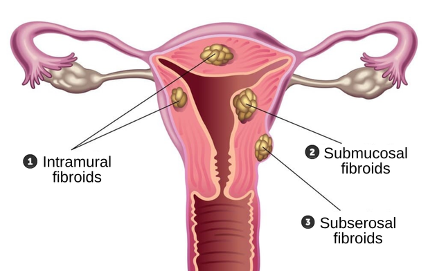 uterine fibroid removal in korea SH Clinic gangnam seoul