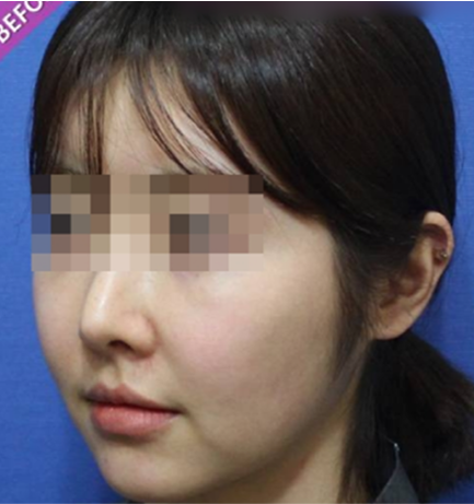 Thread Lifting in Korea at SH Clinic Gangnam Seoul